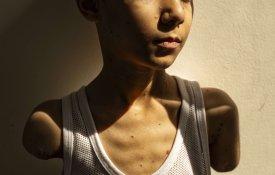 Fotografia de menino palestiniano sem braços vence o World Press Photo