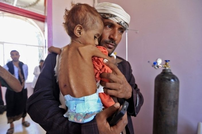 A Unicef estima que aumente o número de crianças em situação de má-nutrição aguda no Iémen em 2021