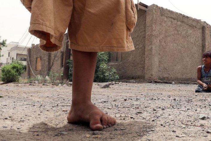 Duas crianças Iemenitas, estropiadas por minas antipessoais, brincam na cidade de Aden, Iémen, uma zona ocupada pelas forças sauditas, com o apoio norte-americano e britânico. 9 de Agosto de 2018 