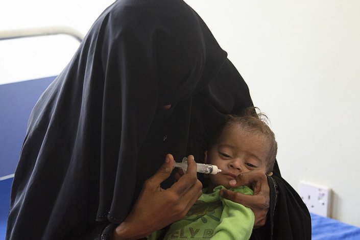 Com a guerra de agressão ao Iémen, milhões de crianças sofrem de desnutrição